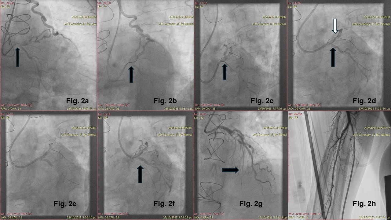 Figure 2. The left main CTO procedure
