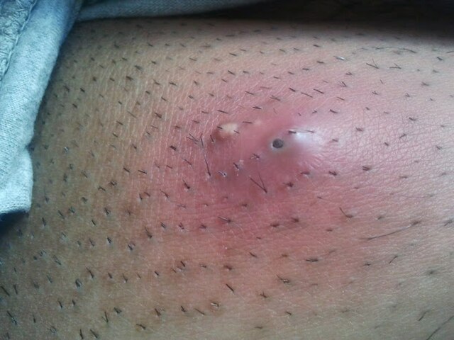 five day old abscess