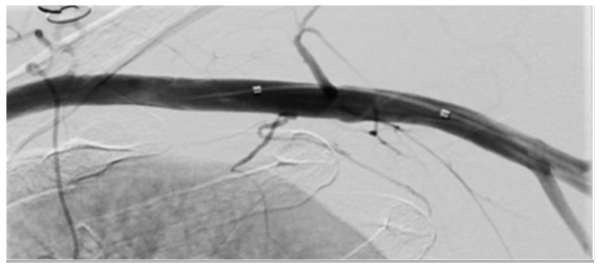 Fong Axillary Access Figure 10