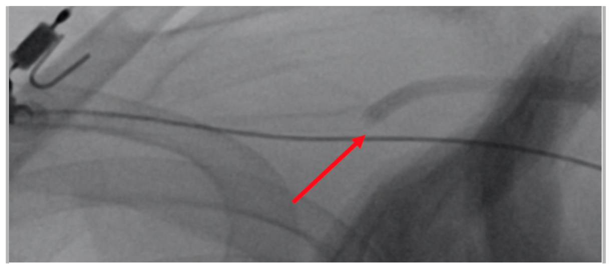 Fong Axillary Access Figure 3