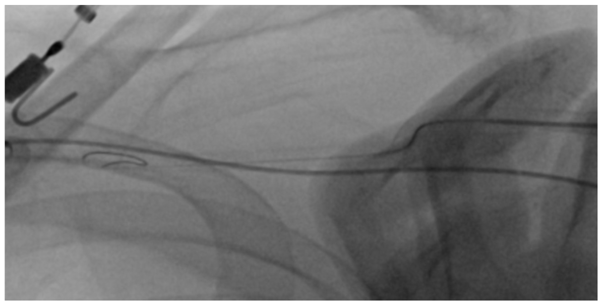 Fong Axillary Access Figure 4