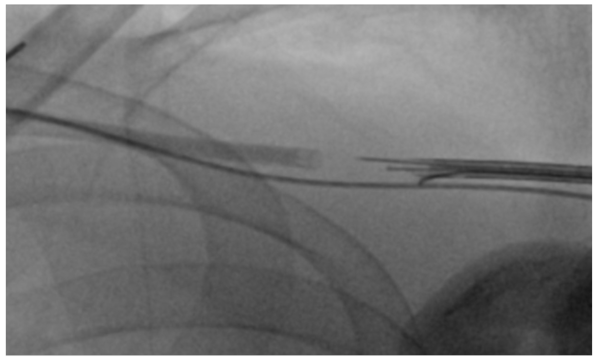 Fong Axillary Access Figure 5