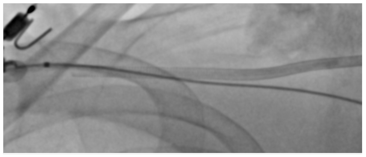 Fong Axillary Access Figure 7