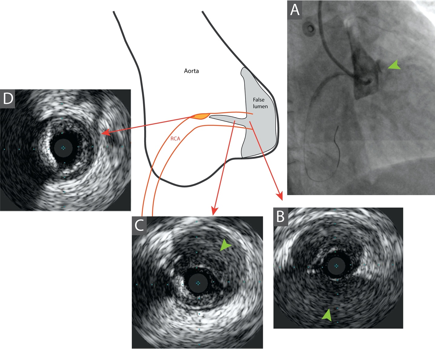 Figure 2. (A) Right coronary angiogram 