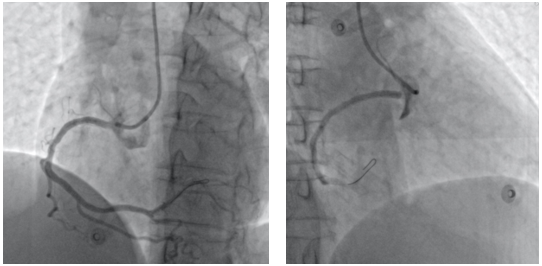 Figure 3. Final angiogram