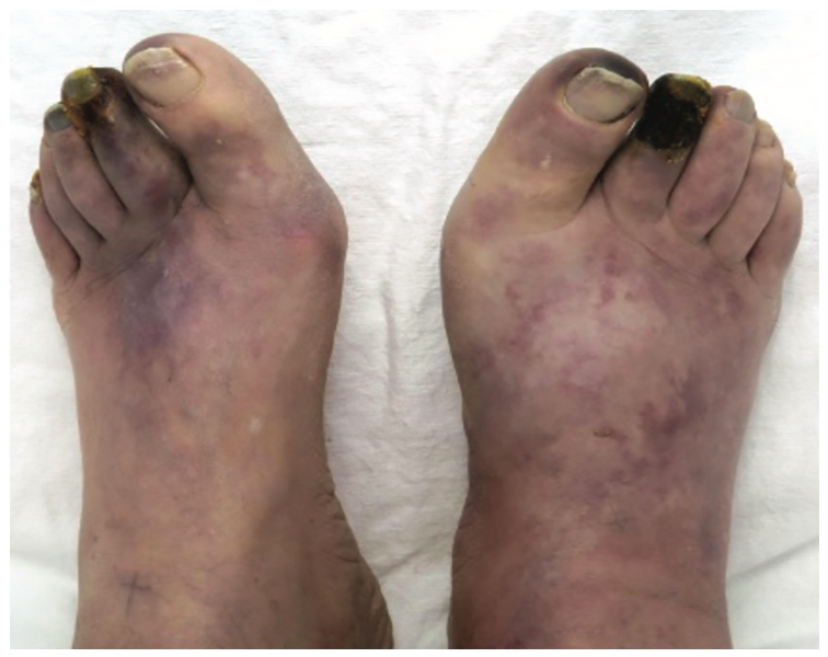 Froetschel Peripheral Vascular Disease Figure 2