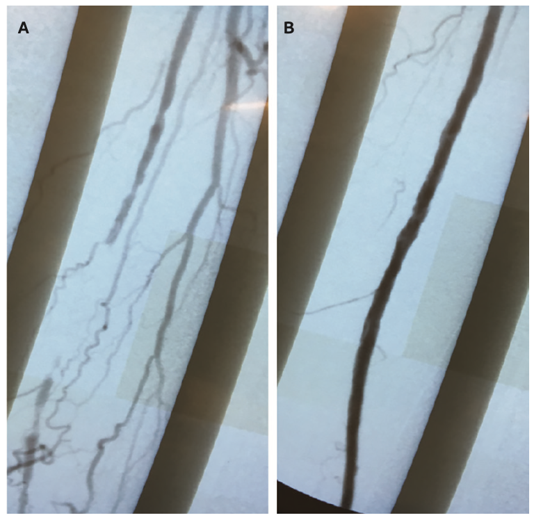 Froetschel Peripheral Vascular Disease Figure 3