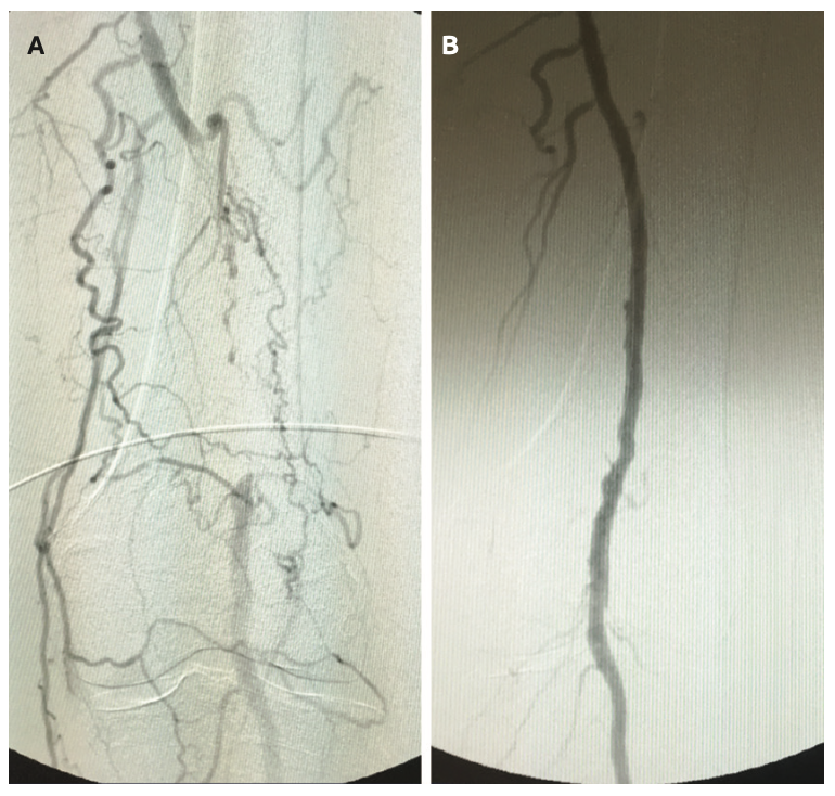 Froetschel Peripheral Vascular Disease Figure 4