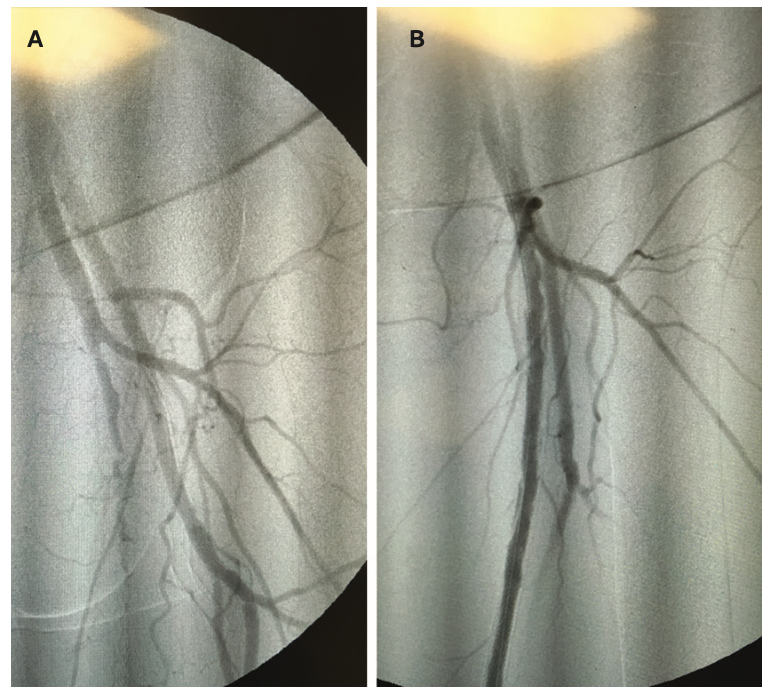 Froetschel Peripheral Vascular Disease Figure 5