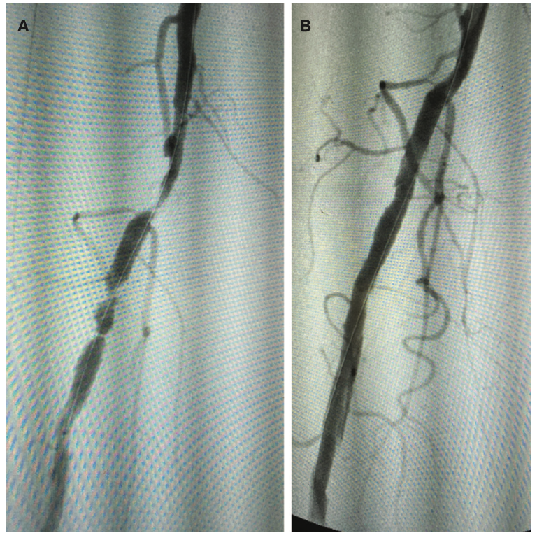 Froetschel Peripheral Vascular Disease Figure 6