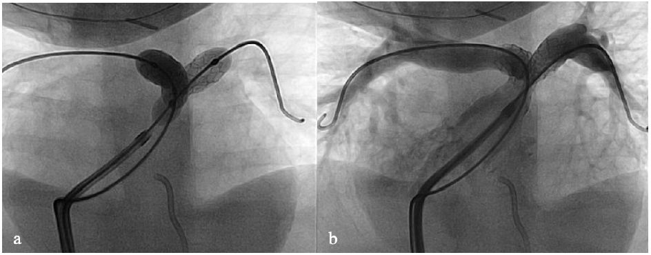 Figure 1. Simultaneous PA bifurcation stent placement.