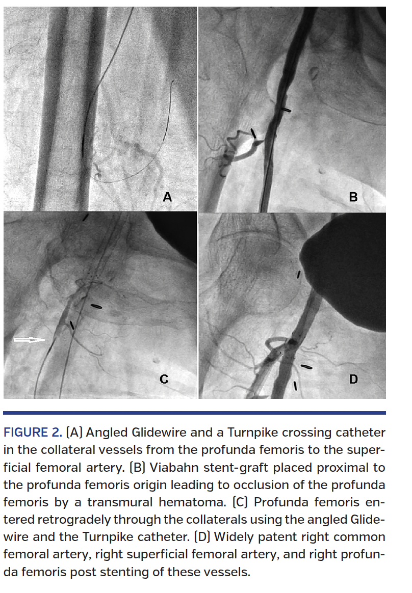 FIGURE 2. (A) Angled Glidewire.png