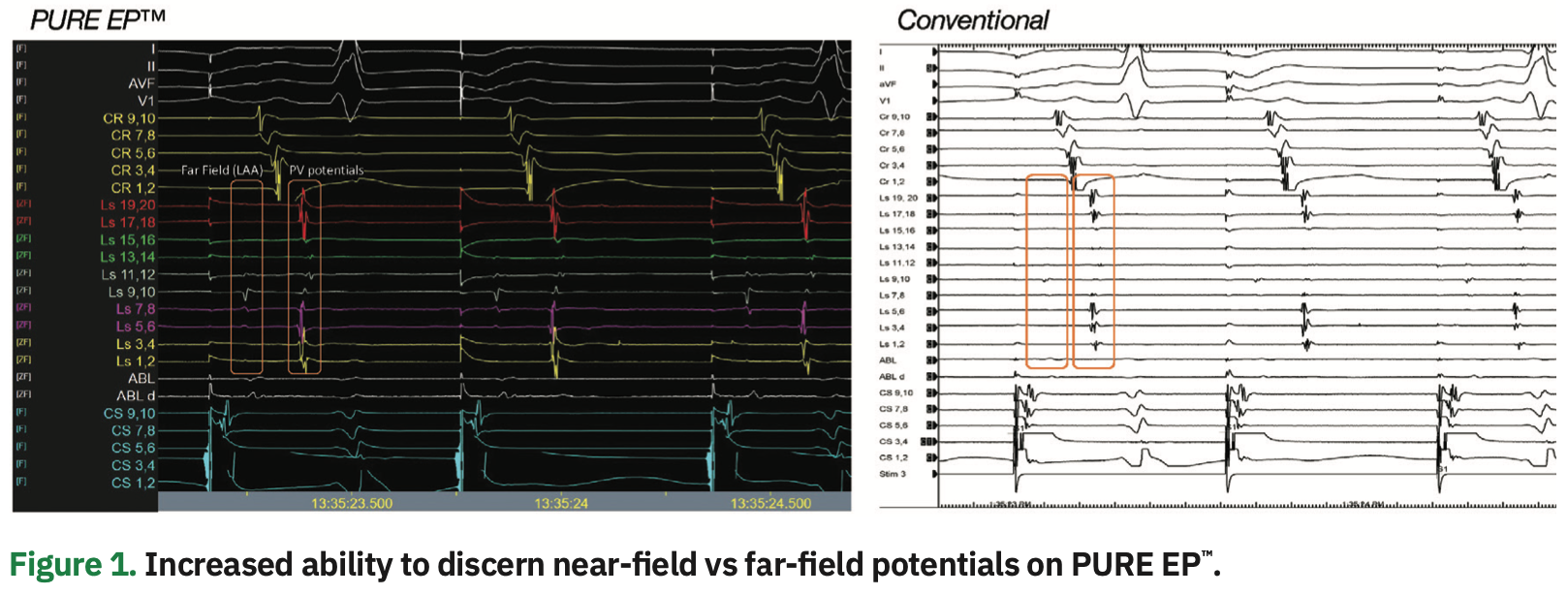 Gallinghouse Intracardiac Figure 1