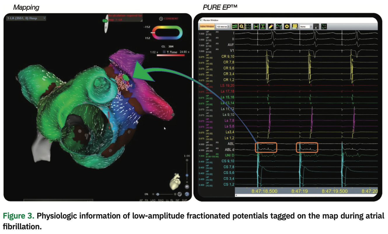 Gallinghouse Intracardiac Figure 3