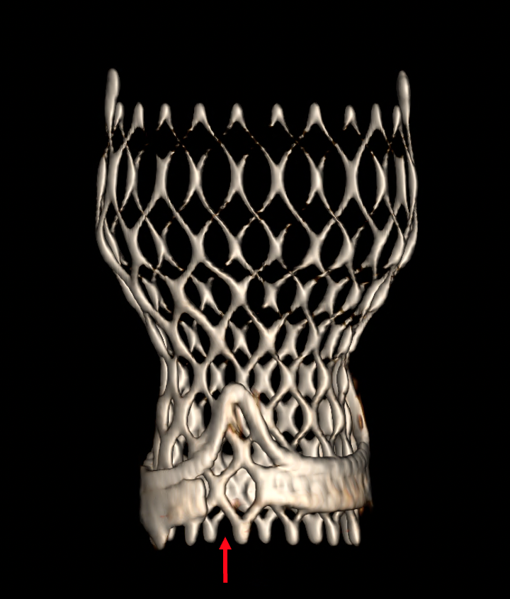 Garcia CLD TVT Bioprosthetic valve fracture