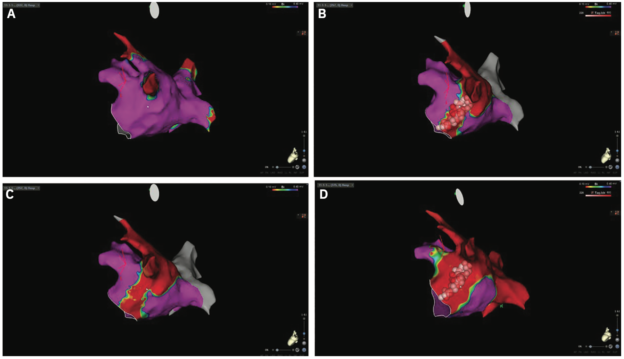 Garg Atrial Flutter Figure 2