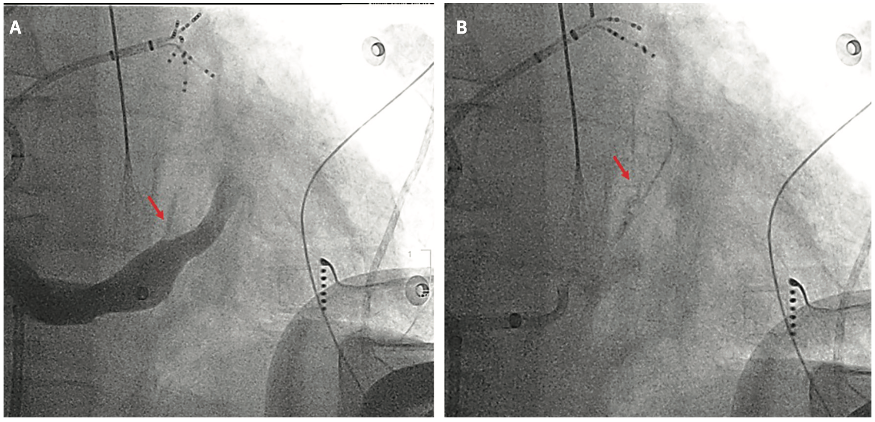 Garg Atrial Flutter Figure 3