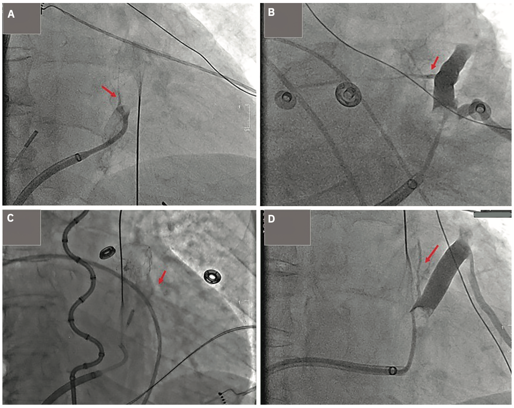 Garg Atrial Flutter Figure 4