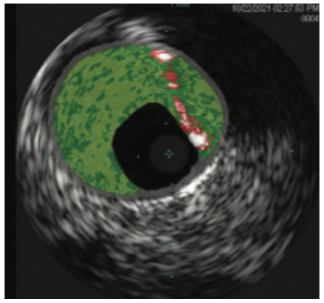 Gbur Multivessel Figure 3