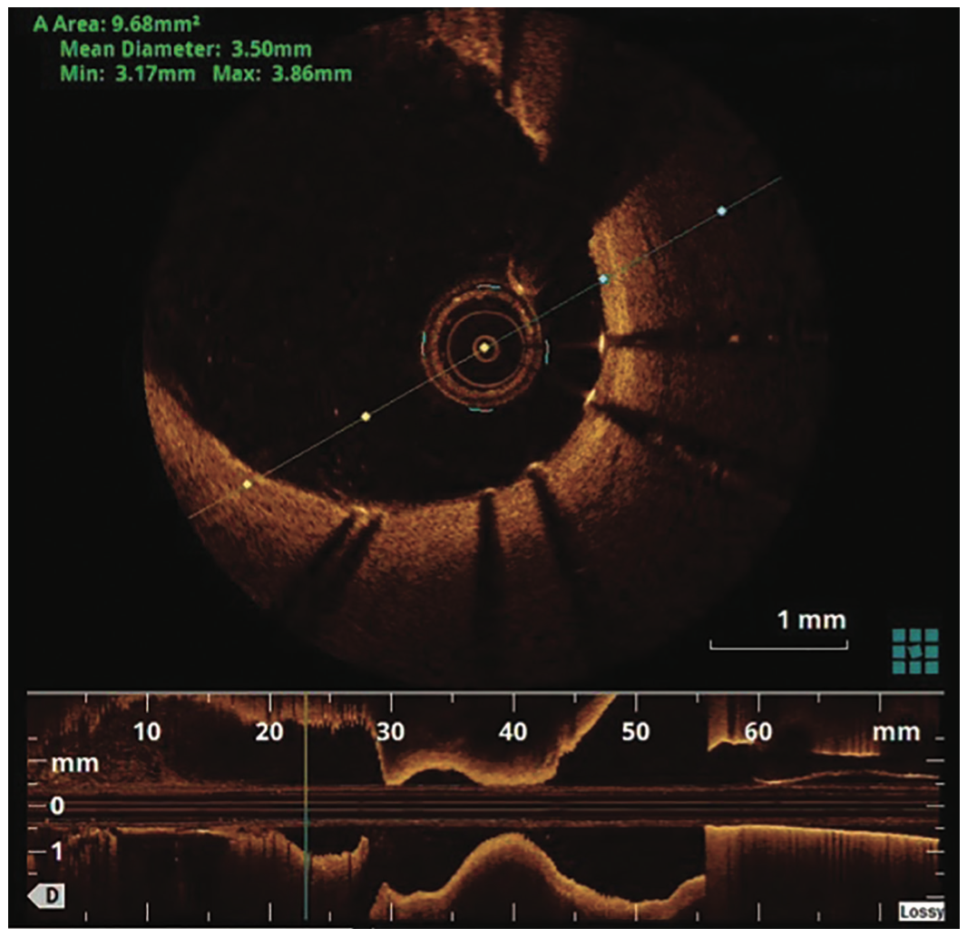 George Covered Stent Figure 2