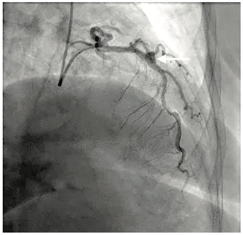 George Covered Stent Figure 3