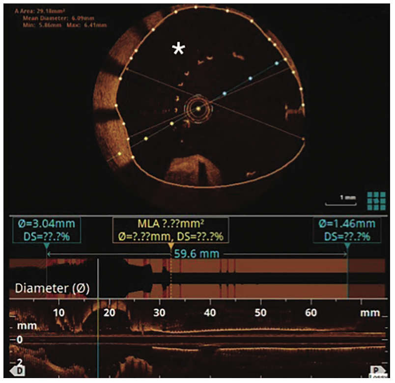 George Covered Stent Figure 4