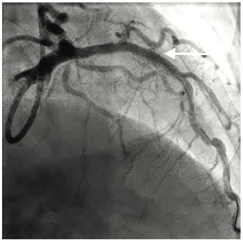George Covered Stent Figure 5