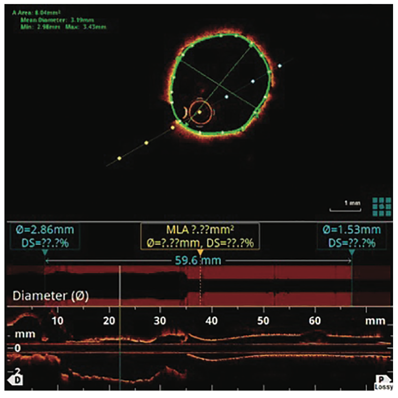 George Covered Stent Figure 6