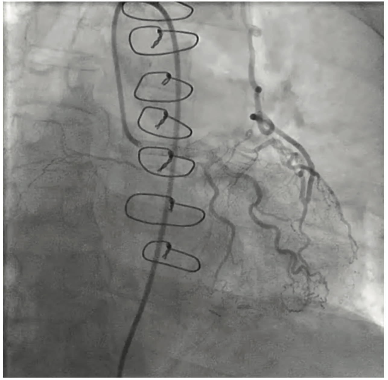 George Recurrent Angina Figure 1