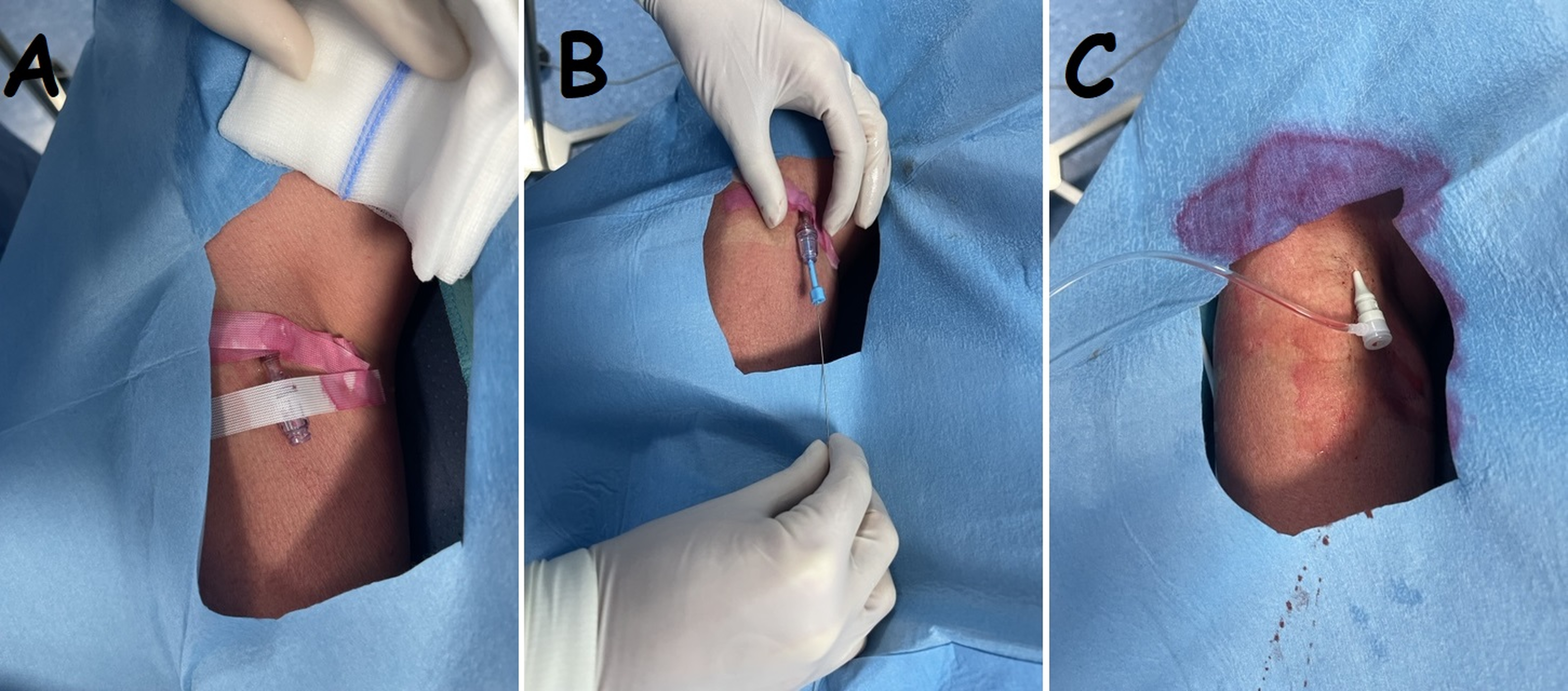 Figure 1. Modified Seldinger’s technique 