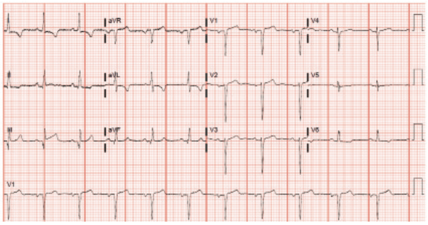 Gogo Angioplasty Figure 1
