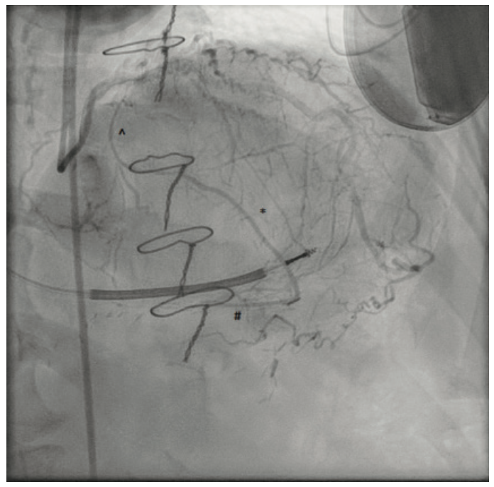Gogo Angioplasty Figure 3