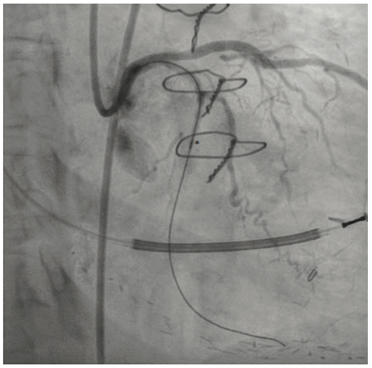 Gogo Angioplasty Figure 5