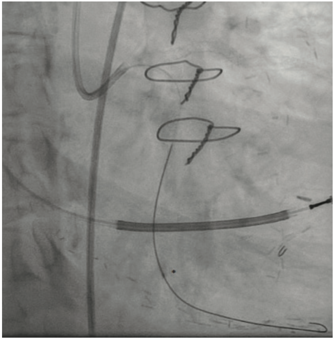 Gogo Angioplasty Figure 6