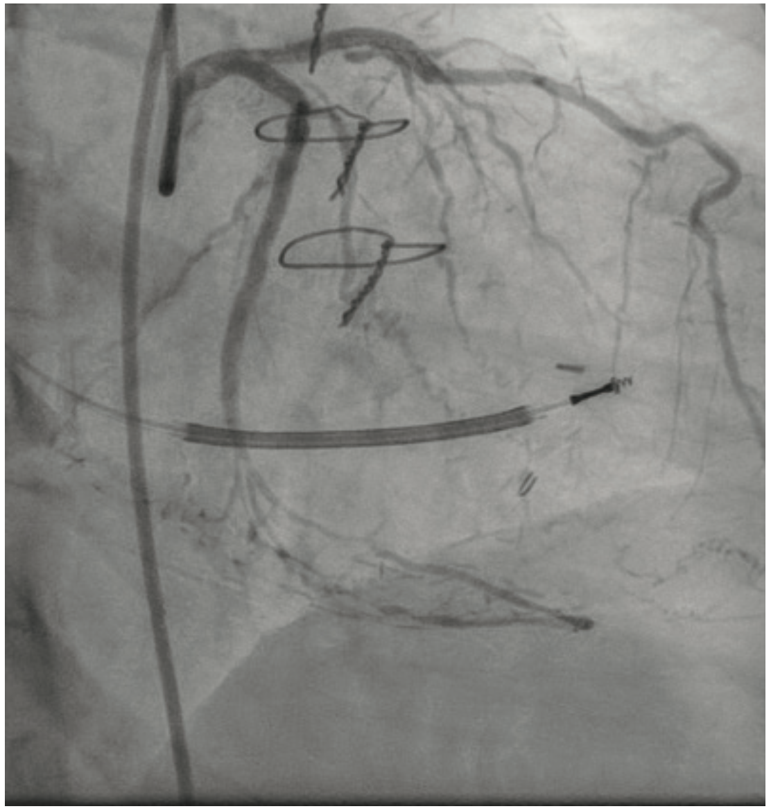 Gogo Angioplasty Figure 7