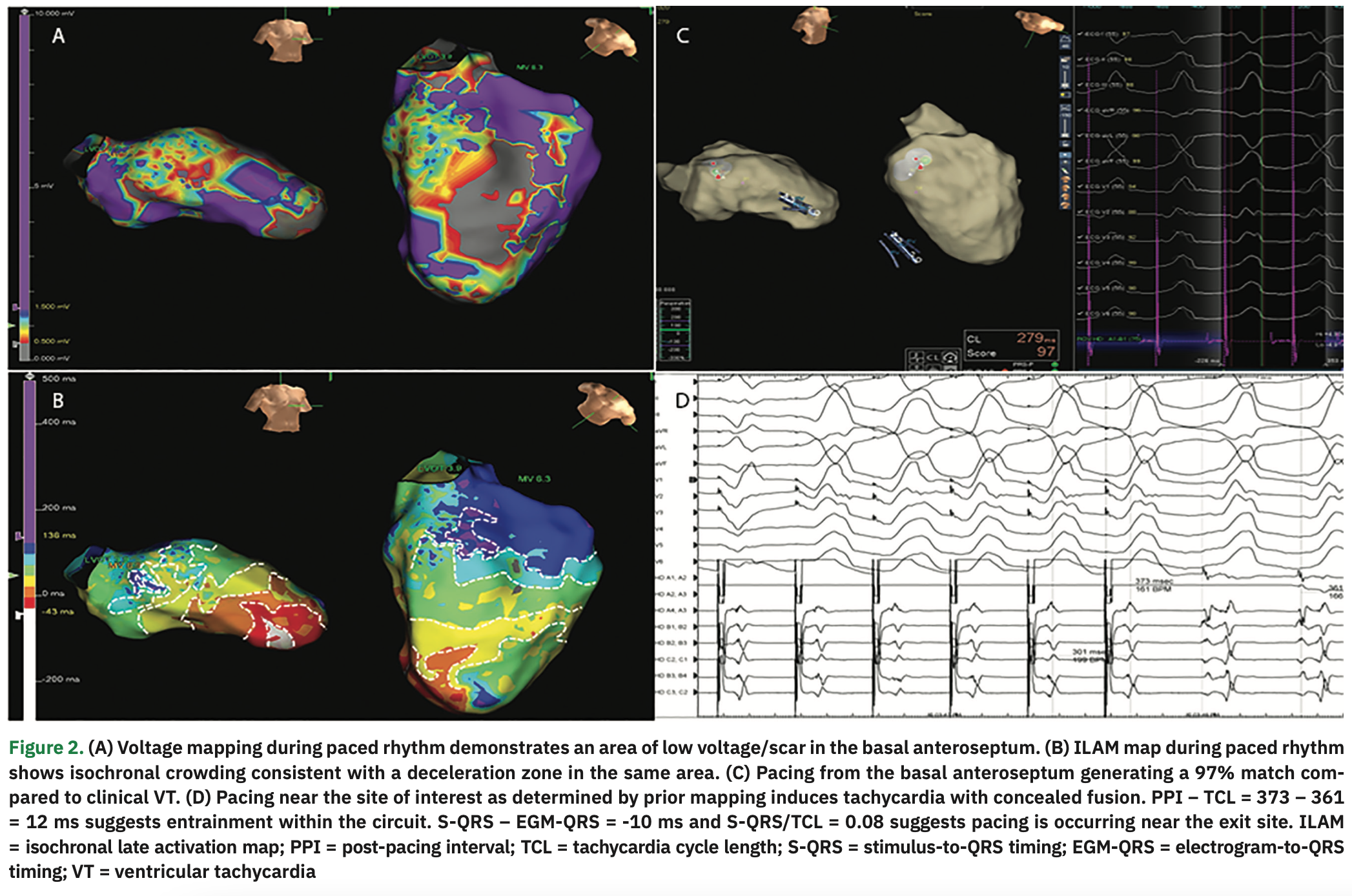 Goldstein Catheter Ablation Figure 2