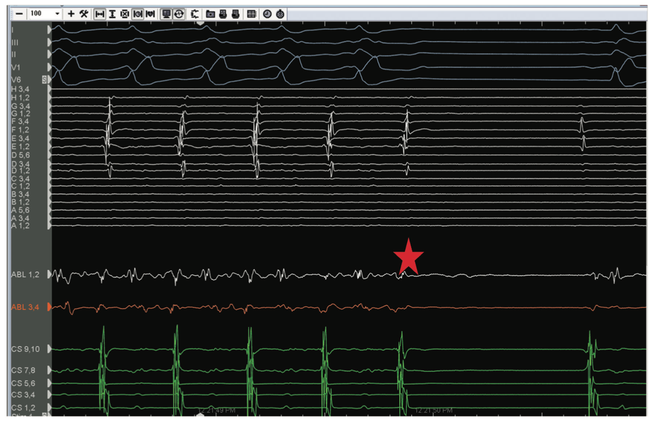Golian Tunnel Vision Figure 10