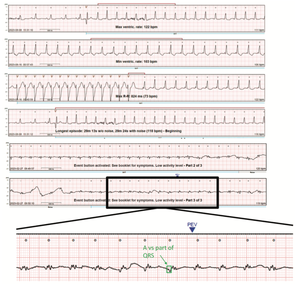 Golian Tunnel Vision Figure 2