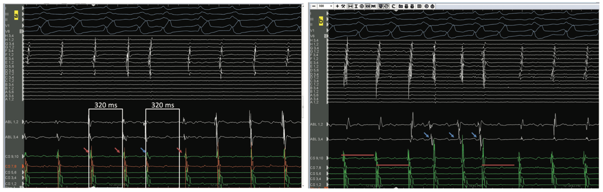 Golian Tunnel Vision Figure 6