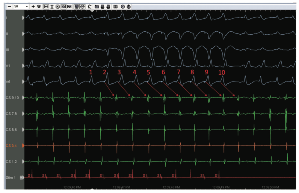 Golian Tunnel Vision Figure 8