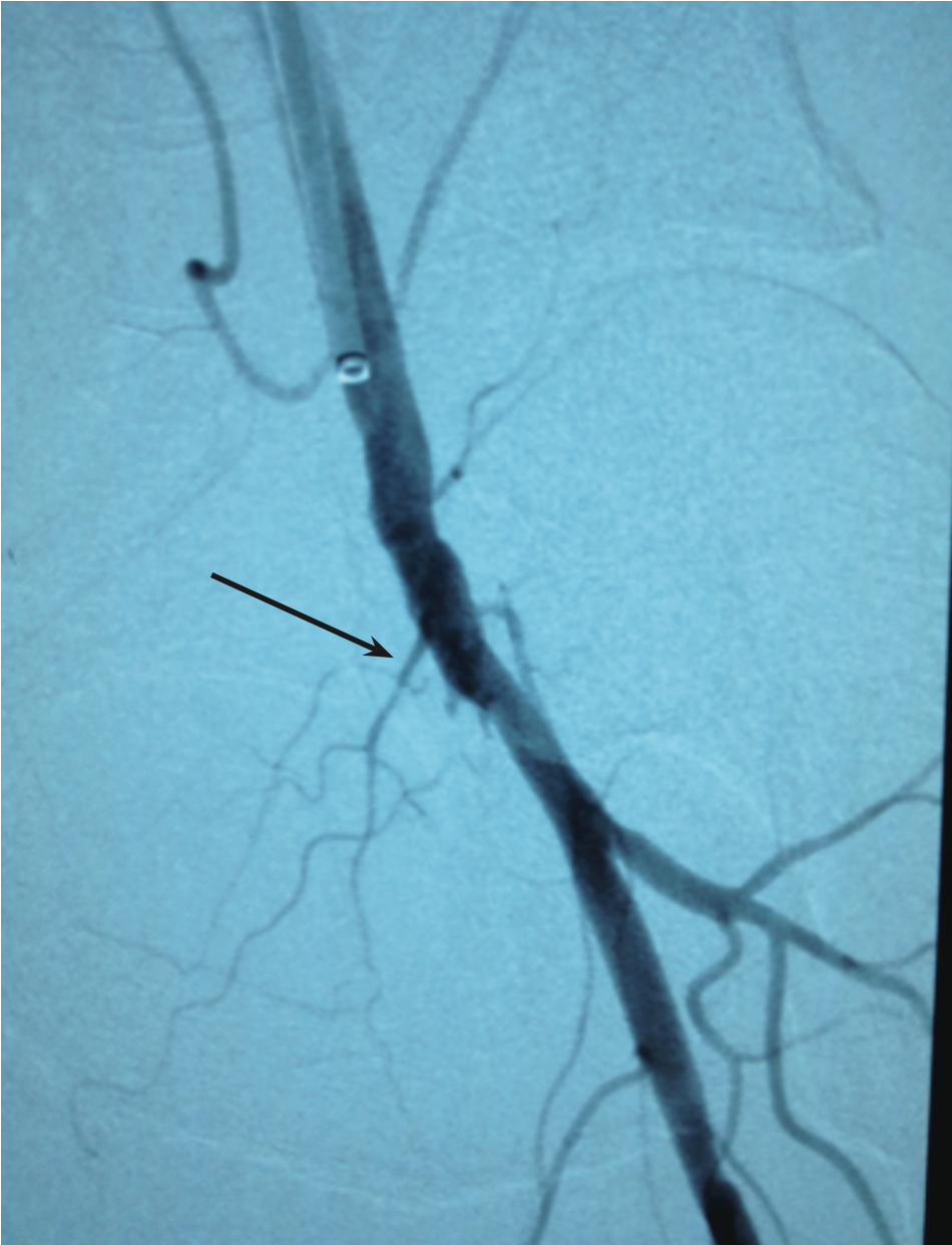 Grullon Critical Limb Ischemia Figure 1
