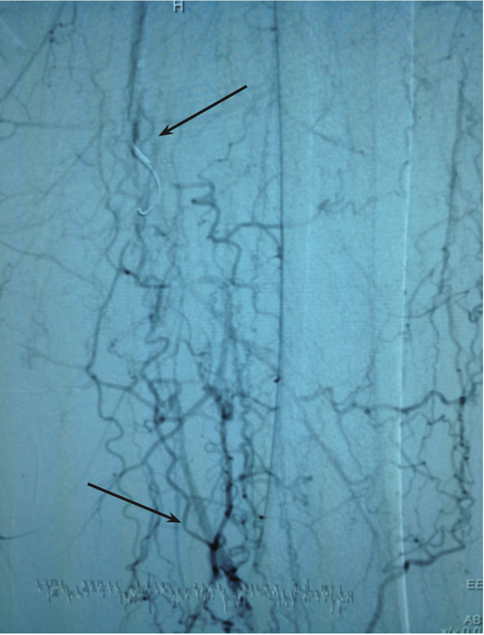 Grullon Critical Limb Ischemia Figure 2