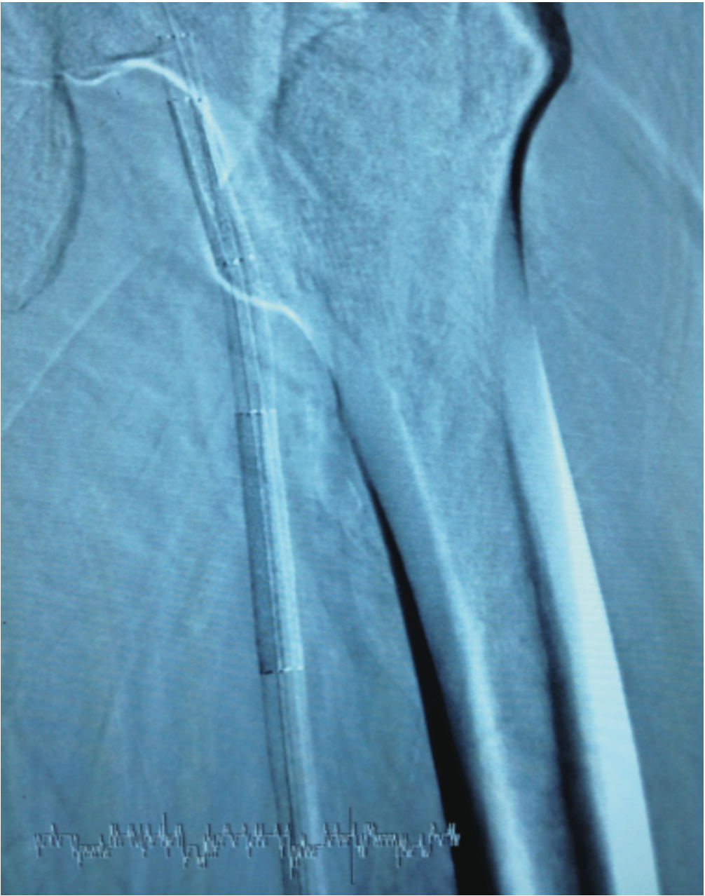 Grullon Critical Limb Ischemia Figure 6