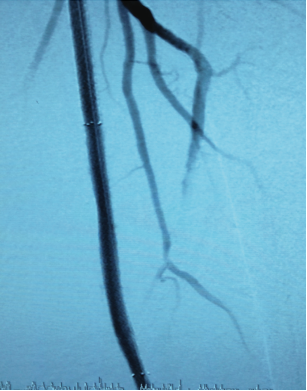 Grullon Critical Limb Ischemia Figure 7