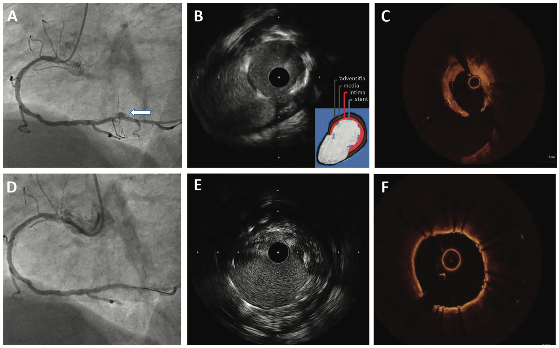 Guerrero Intracoronary Imaging Figure 1