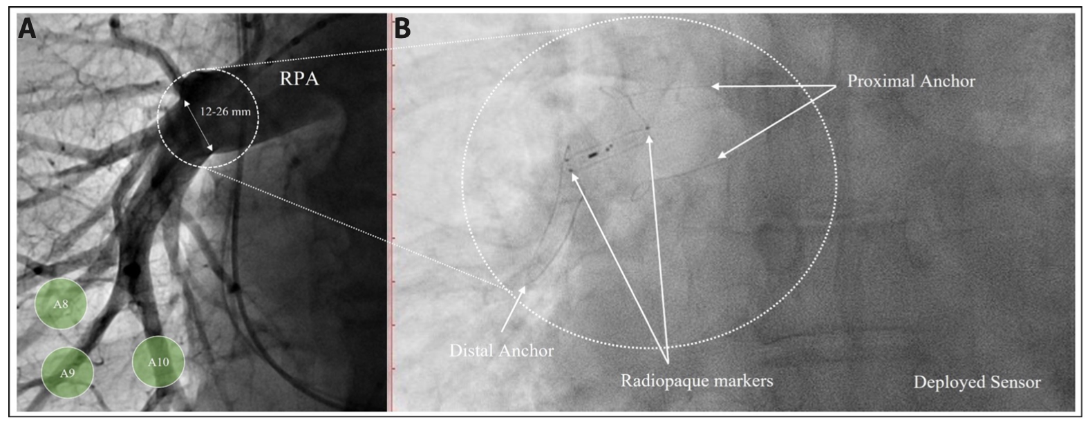 Guichard Pulmonary Artery Figure 3