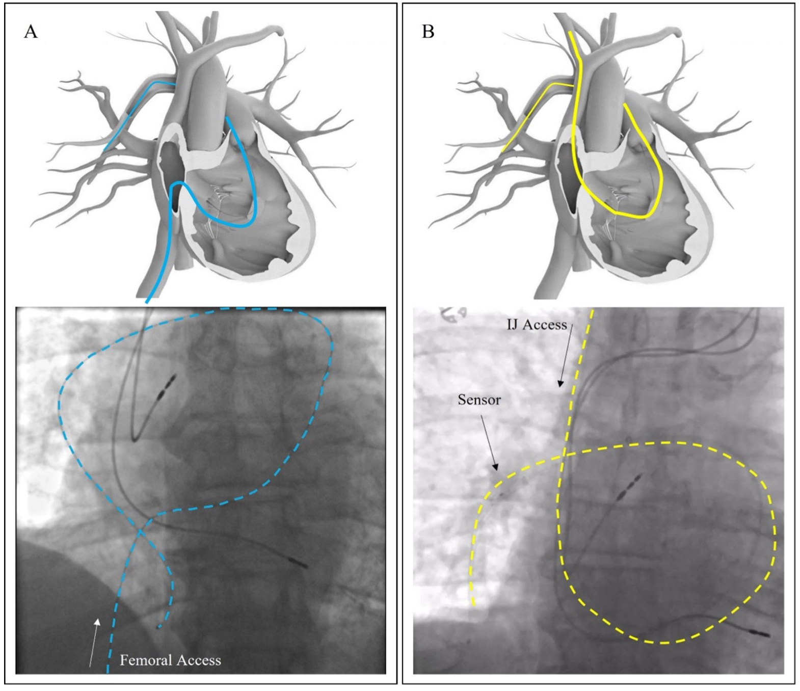 Guichard Pulmonary Artery Figure 5