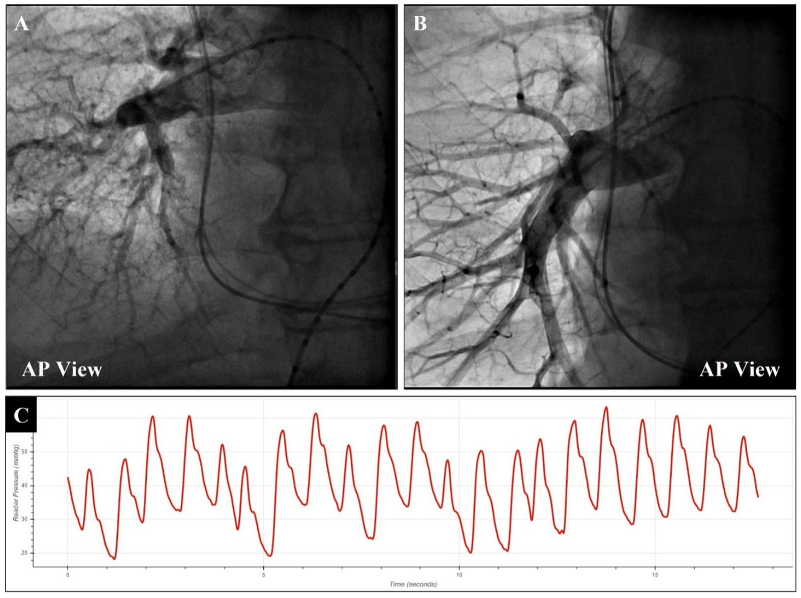 Guichard Pulmonary Artery Figure 6