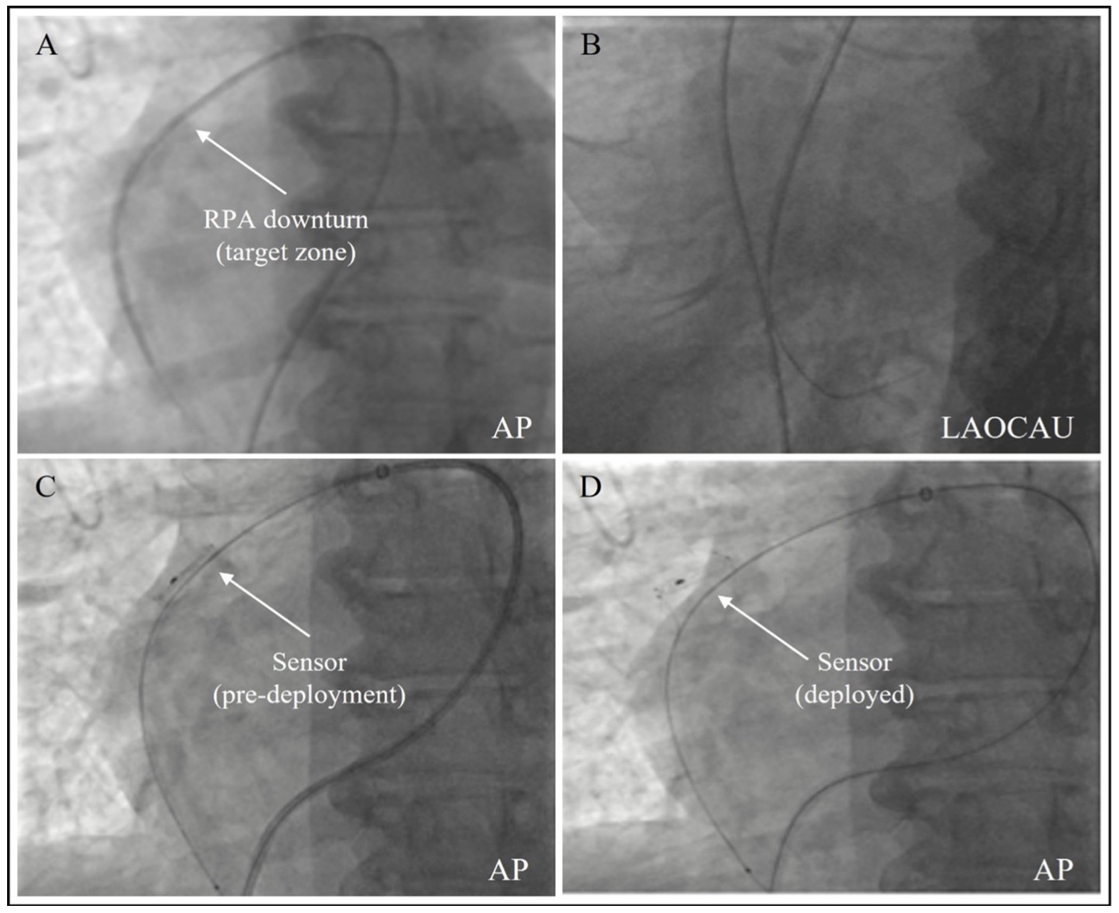 Guichard Pulmonary Artery Figure 7