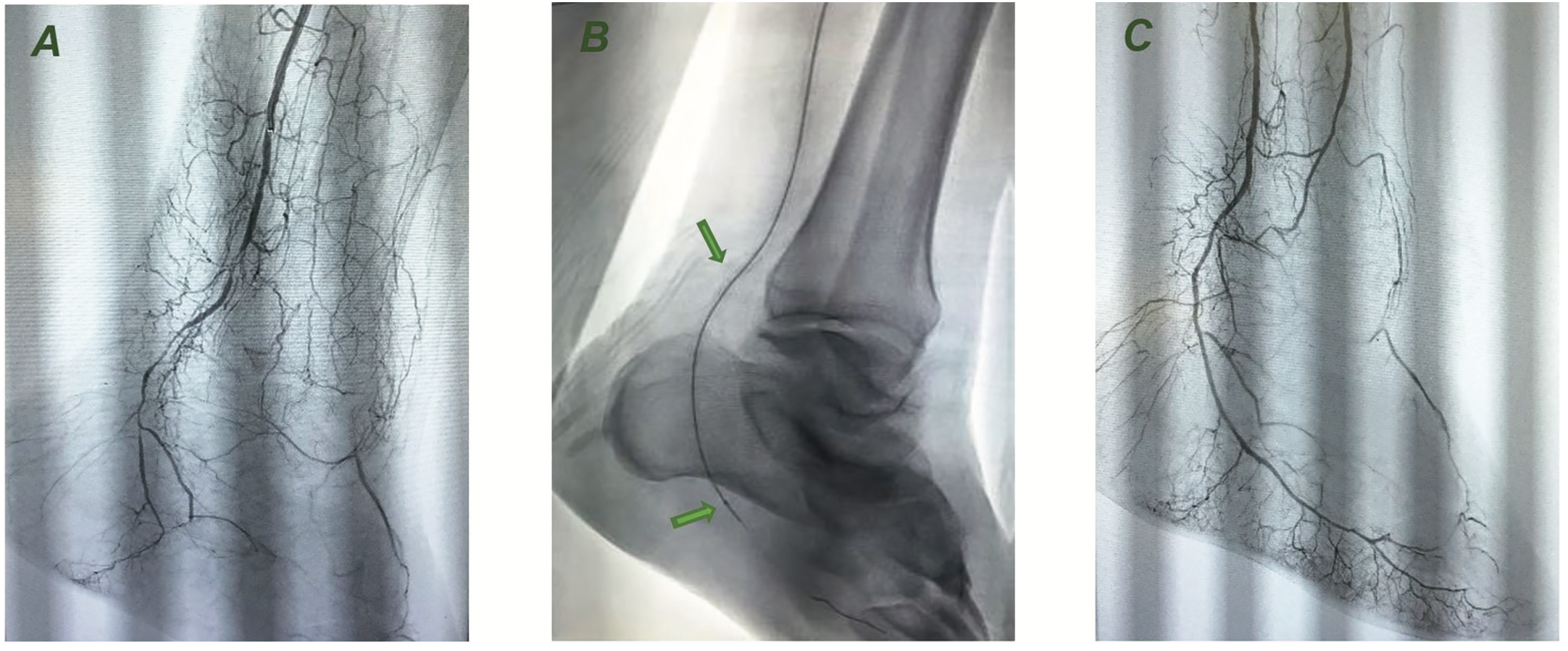 Gupta Limb Salvage Figure 1